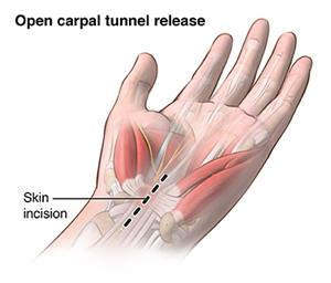 Cubital Tunnel Syndrome  Saint Luke's Health System