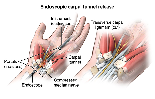 Cubital Tunnel Syndrome  Saint Luke's Health System