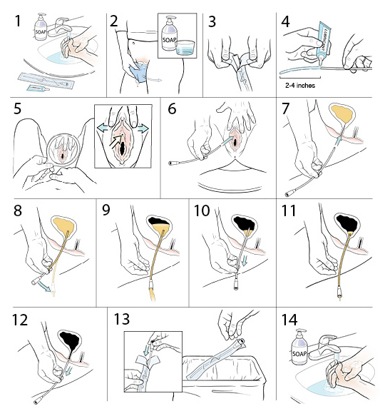 Step By Step Inserting A Disposable Catheter Woman Saint Luke S Health System