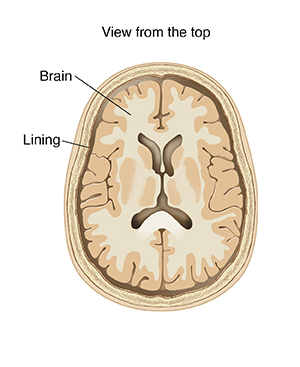 Meningitis: Meaning, Symptoms, and Treatment