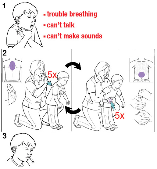 Heimlich Maneuver Child