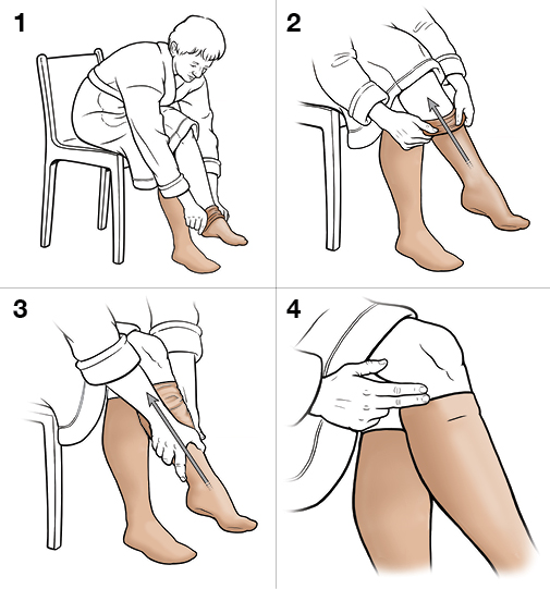 StepbyStep Putting on KneeHigh Compression Stockings Saint Luke's