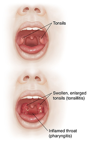 When You Have a Sore Throat | Saint Luke's Health System