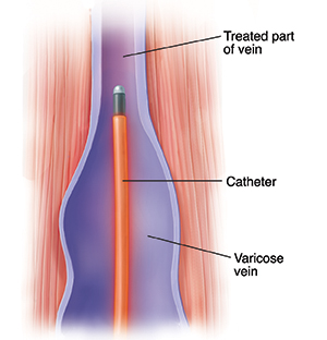 Varicose Veins Treatment: Laser Ablation Therapy - VIVAA