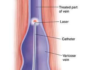 Endovenous Laser Treatment (EVLT) for Varicose Veins