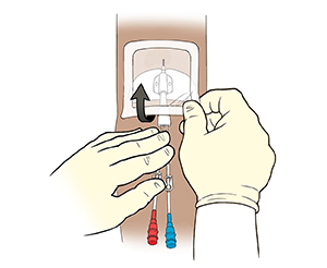 Closeup of arm with midline catheter. One gloved hand  holding catheter while other gloved hand pulls up corner of dressing.