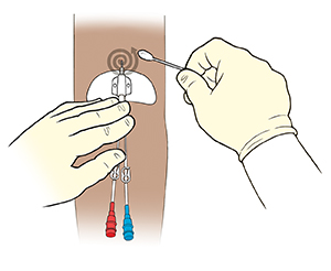 Closeup of arm with midline catheter. One gloved hand  holding catheter against arm while other gloved hand cleans around site with a swab. Arrow shows cleaning in a spiral motion moving out from the insertion site.