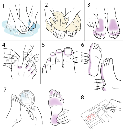 StepbyStep Inspecting Your Feet (Diabetes) Saint Luke's Health System
