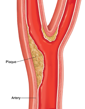Cross section of carotid artery showing plaque buildup. 