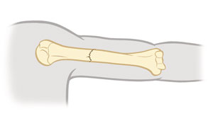 Common Types of Fractures Saint Luke s Health System