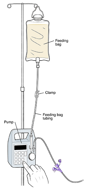 Continuous tube feeding change bag sale