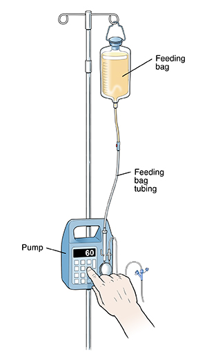 Your Child's Nasogastric Tube: Pump Feeding