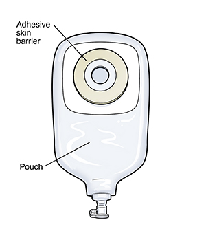 One-piece drainable urostomy pouch.