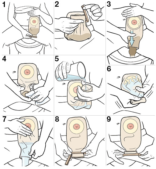 emptying stoma pouch estoma
