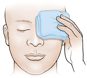 Understanding Noninfectious Red Eye Treating Inflammation Saint