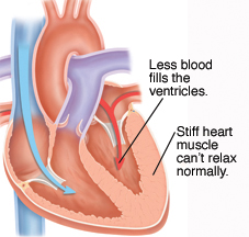 Cross section of heart with diastolic heart failure.