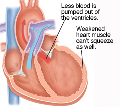 Cross section of dilated heart with systolic heart failure.