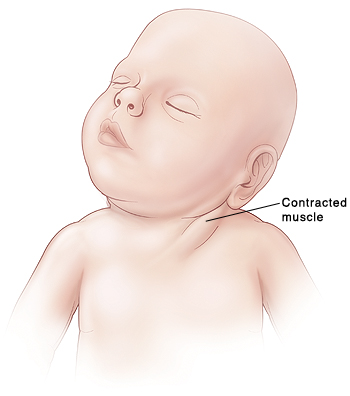 When Your Child Has Congenital Muscular Torticollis Saint Luke S Health System