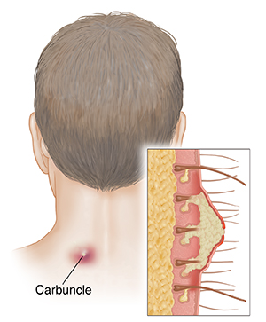 Understanding Carbuncles | Saint Luke's Health System