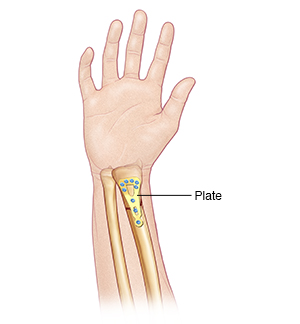 Treating Wrist Fractures Saint Luke s Health System