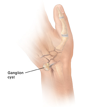 Back view of hand showing dotted line around ganglion cyst on wrist.