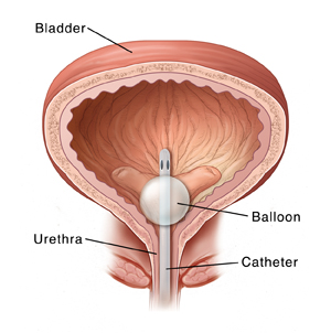 Inflamed Urethra Urinary Tract Photos and Images & Pictures