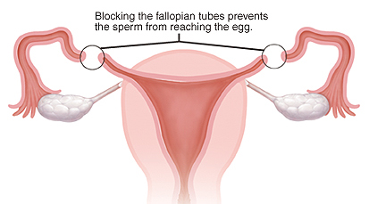 Tubal ligation