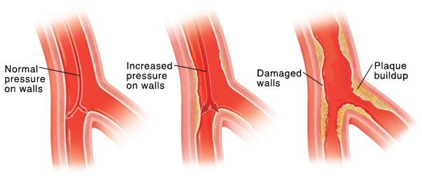 Blood flows freely through a healthy artery. Artery walls are roughened by high blood pressure. This makes it easier for plaque to build up. Plaque collects, narrowing and stiffening the wall of the artery.