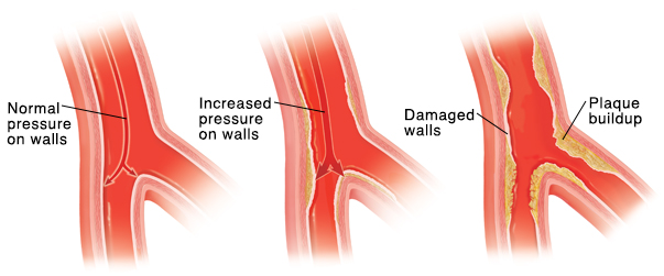 Understanding Your Blood Pressure