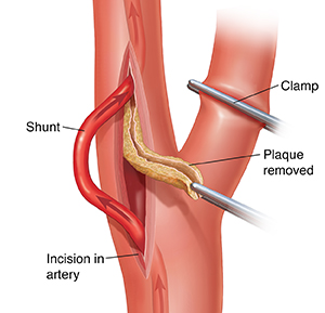 femoral artery pain