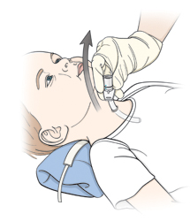 child tube trach tracheostomy change clean under removing inserting neck