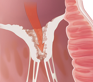 Close-up of stenotic heart valve unable to completely open.