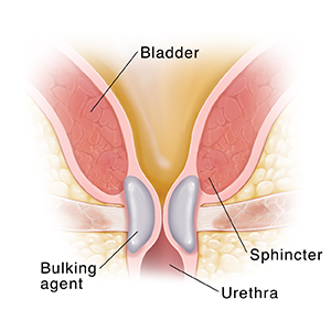 A urethral bulking agent for female stress urinary incontinence - Bulkamid