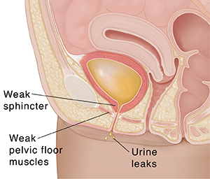 Rela Hospital on X: Stress urinary incontinence is leaking urine