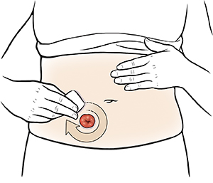 How to Clean an Ostomy Pouch