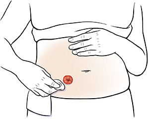 Colostomy: Changing Your Pouch