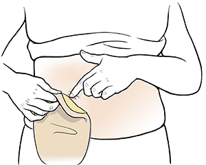 How to Clean an Ostomy Pouch