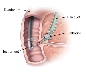 ERCP: What It Is, Why It's Done, Procedure & Complications