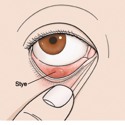 lower eyelid