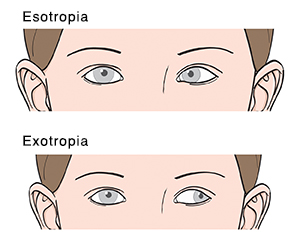 Strabismus Causes And Treatments Saint Luke S Health System