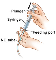 Your Child S Nasogastric Tube Flushing The Tube Saint Luke S Health System