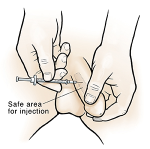 Saline Penis Injection