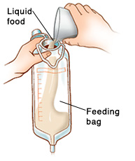 Closeup of hands pouring liquid food into feeding bag.