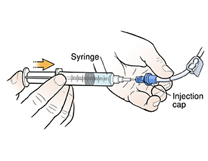 Discharge Instructions Flushing Your Central Venous Catheter Saint Luke S Health System