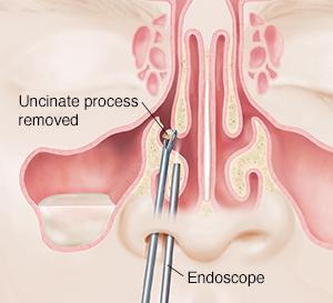 Clearing sinus on sale