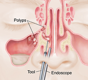 Endoscopic Sinus Surgery Saint Luke S Health System