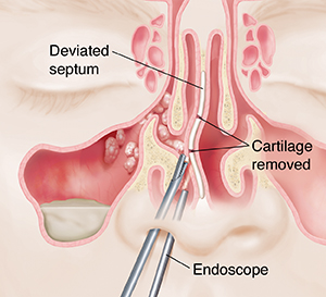 Closeup of instruments inserted in nose, repairing deviated septum. Sinus has polyps.