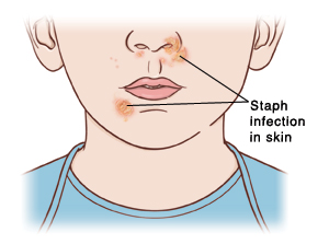 Staph Infection (Non-MRSA) | Saint Luke's Health System