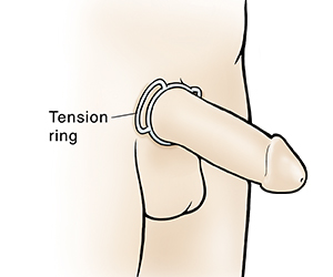 How A Penis Ring Can Improve Your Erections