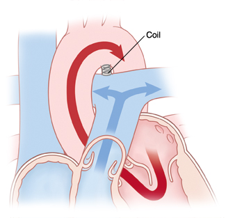 When Your Child Has a Patent Ductus Arteriosus PDA Saint